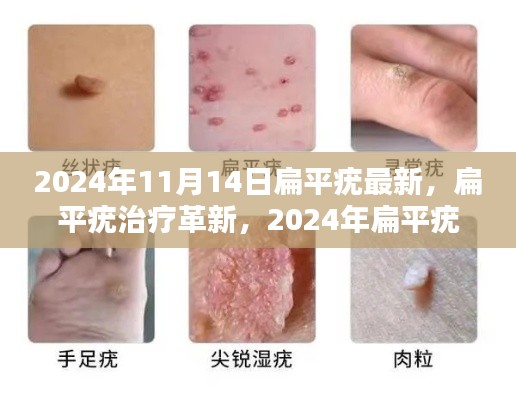 2024年扁平疣治疗革新与产品全面评测,最新扁平疣产品介绍